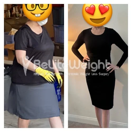 Sleeve to RNY Bypass Revision before and after Patient - Hello!I am doing amazing thank you:) I have exceeded my weight reduction goal! I've lost 67lbs...