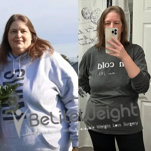 Weight Loss Surgery Before And After
