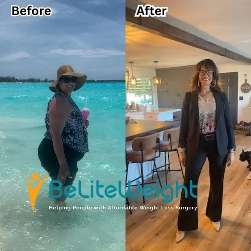 Weight Loss Surgery Gastric Sleeve before and after