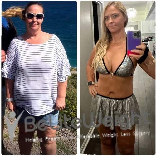 Weight Loss Surgery Gastric Sleeve before and after