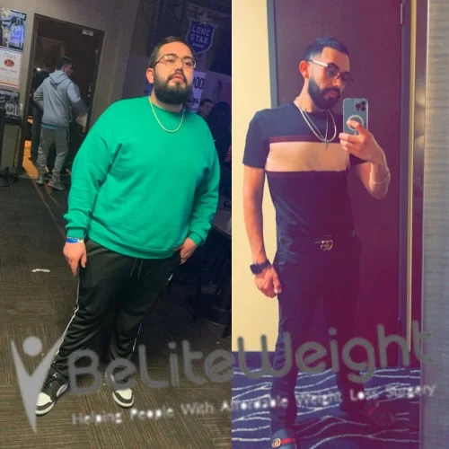 Weight Loss Surgery Before And After