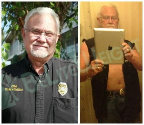 weight loss surgery vsg vertical gastric sleeve bypass before and after