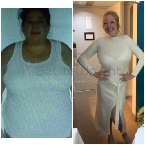 Sleeve to RNY Bypass Revision before and after Patient - Hi, I am doing well ty!!! I'm at 164 now!!! And closer to my 150...