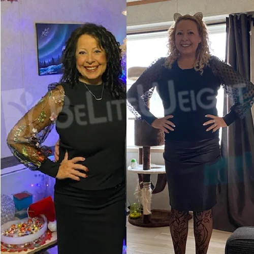 Weight Loss Surgery Gastric Sleeve before and after