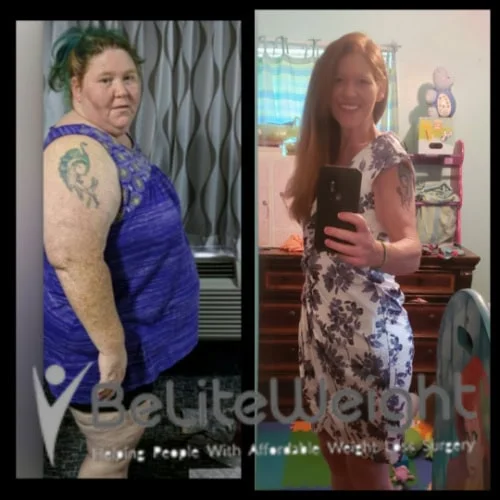 Weight Loss Surgery Before And After