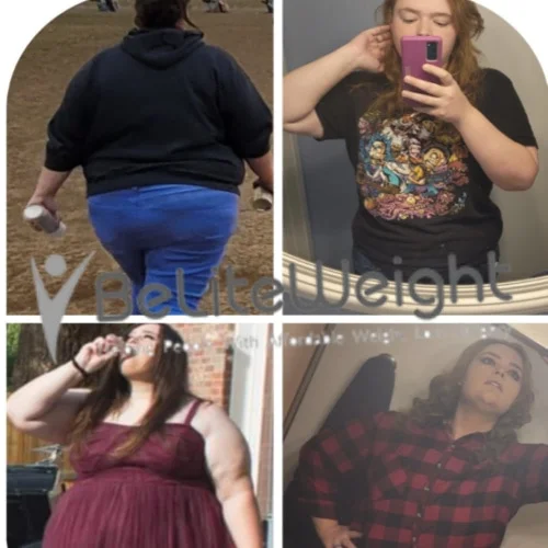 Weight Loss Surgery Before And After