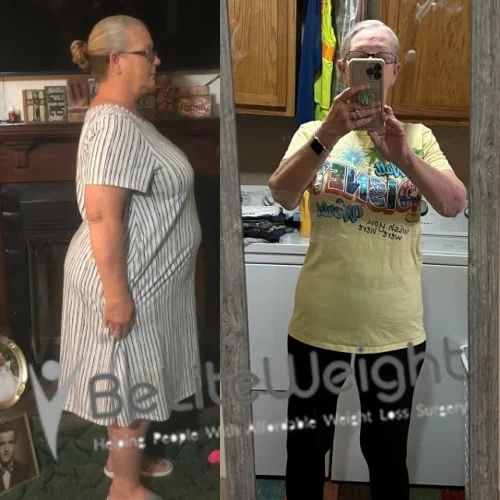 Weight Loss Surgery Before And After