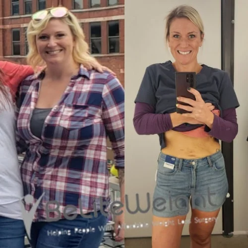 Weight Loss Surgery Gastric Sleeve before and after