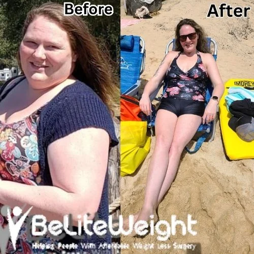 Weight Loss Surgery Gastric Sleeve before and after