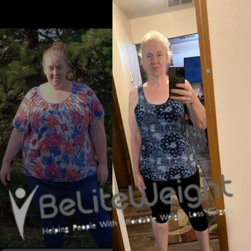 Weight Loss Surgery Gastric Sleeve before and after
