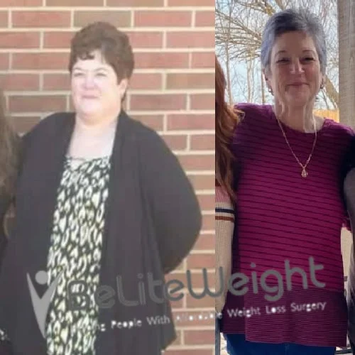 Weight Loss Surgery Gastric Sleeve before and after