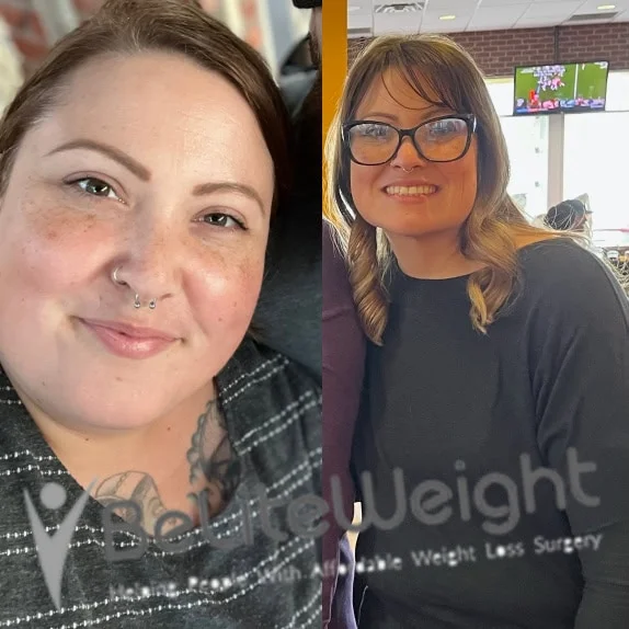 Weight Loss Surgery Gastric Sleeve before and after