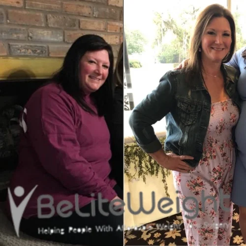 Weight Loss Surgery Before And After