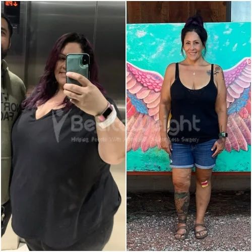 RNY Gastric Bypass before and after Patient - Hey JoAnne, I am doing great. Not done losing yet. Got about 17lbs to go, so...