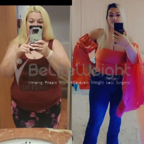 Gastric Sleeve before and after Patient - Hi! I am doing great. I have been at 165 for a long time.Thank you. Gastric...