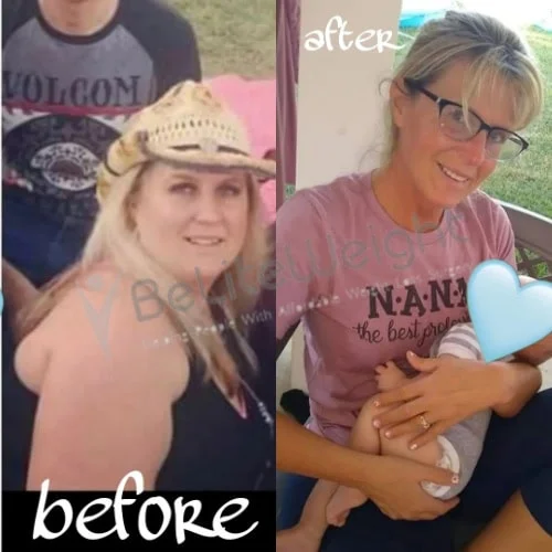 Weight Loss Surgery Gastric Sleeve before and after