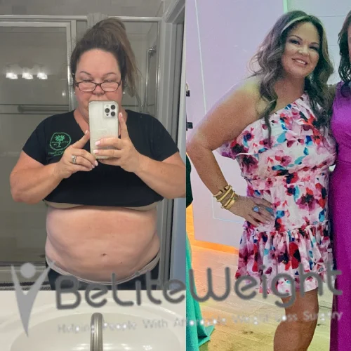 Weight Loss Surgery Before And After