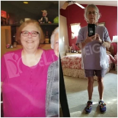 Metabolic Mini Gastric Bypass