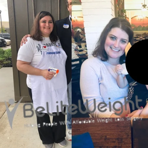 Gastric Sleeve before and after Patient - I'm doing good! I started at 240 two years ago and I lost down to...