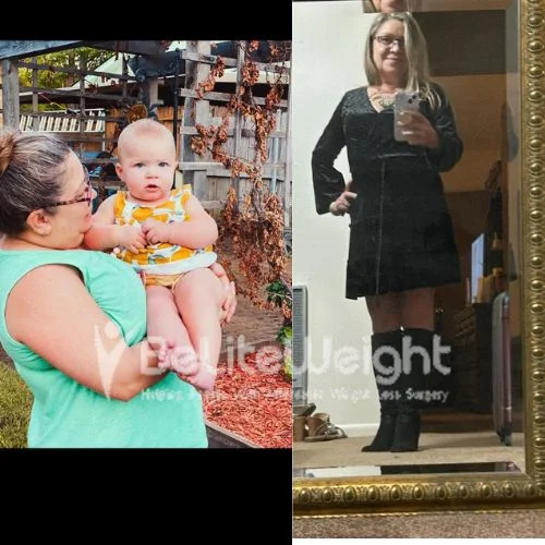 Sherrie G- gastric sleeve 2 years update*