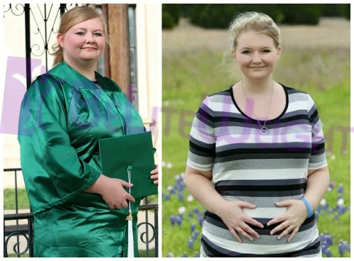 weight loss surgery vsg before and after gastric bypass sleeve vertical