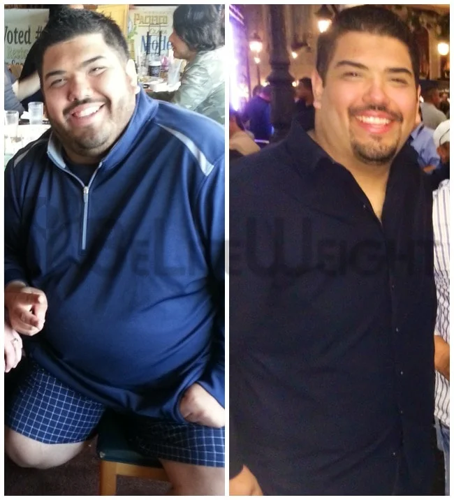 Vertical Sleeve Gastrectomy