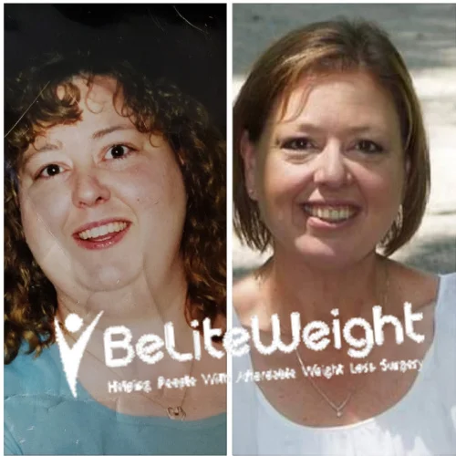 Mini Gastric Bypass before and after Patient - Maintaining my weight and feel 1000 percent better!Band to Mini Bypass RevisionSurgeons: The surgical team...