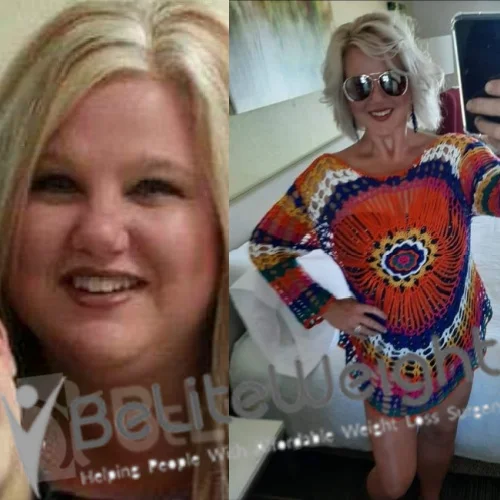 Weight Loss Surgery Before And After