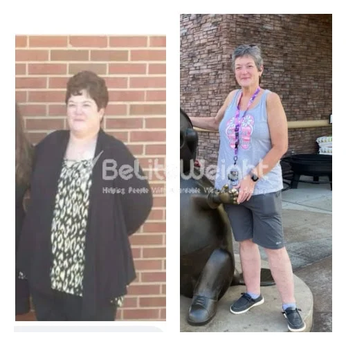 Metabolic RNY Bypass for Diabetes before and after Patient - Hi JoAnne! Great hearing from you. Doctors feel like I have done well keeping weight...