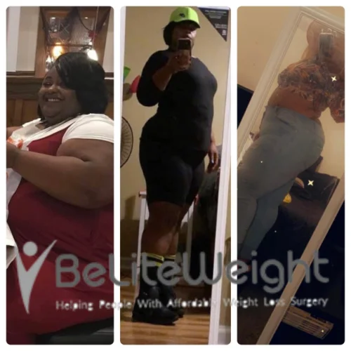 Weight Loss Surgery Gastric Sleeve before and after