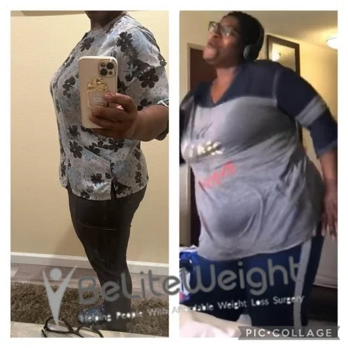 Weight Loss Surgery Gastric Sleeve before and after