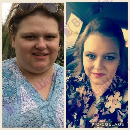 weight loss surgery vsg before and after revision lap band to gastric sleeve