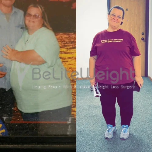 Weight Loss Surgery Before and After