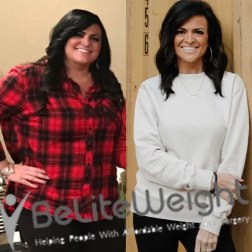 Weight Loss Surgery Gastric Sleeve before and after