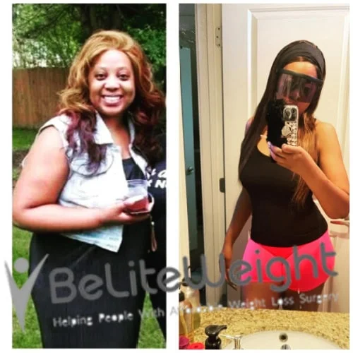 Weight Loss Surgery Gastric Sleeve before and after