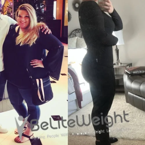 Weight Loss Surgery Before And After