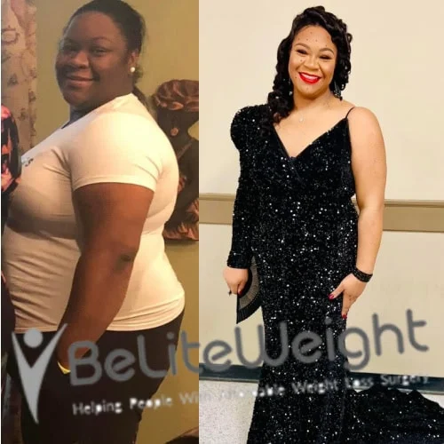 Weight Loss Surgery Gastric Sleeve before and after