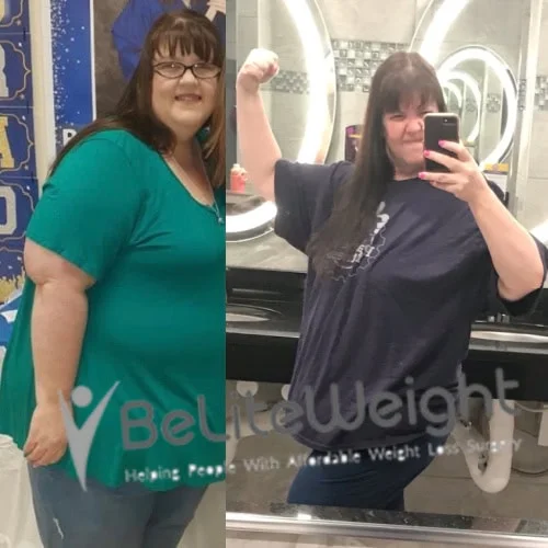 Weight Loss Surgery Before And After