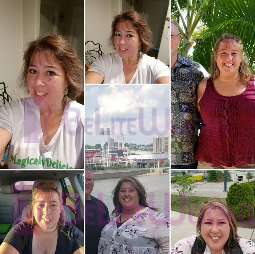 Weight Loss Surgery before and after Patient - I feel amazing !! 105lbs lost. Thank you!! ...best decision have ever had. Surgeon Dr....