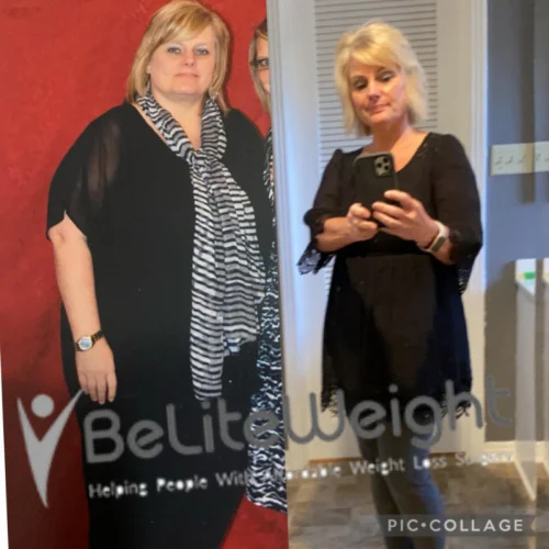 Weight Loss Surgery Gastric Sleeve before and after