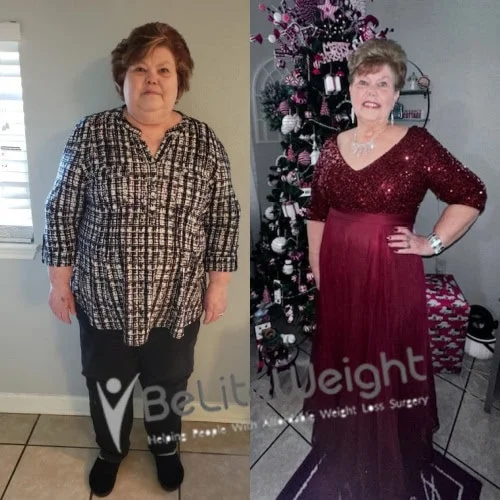 Sleeve to RNY Bypass Revision before and after Patient - I have pretty much maintained  my weight. I am doing well. My life has changed  so much for...