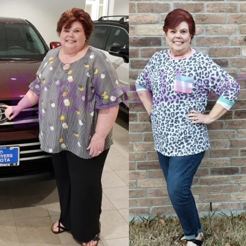Gastric Sleeve before and after