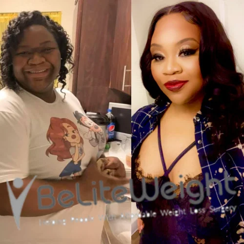 Weight Loss Surgery Gastric Sleeve before and after