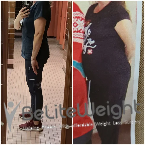 Weight Loss Surgery Gastric Sleeve before and after