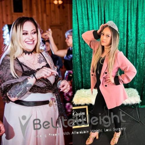 Weight Loss Surgery Gastric Sleeve before and after