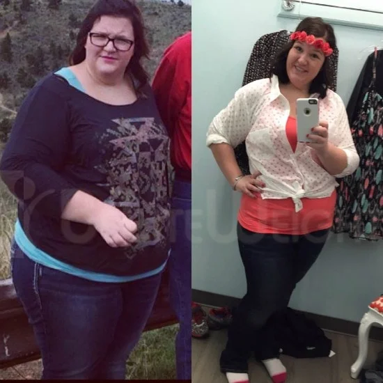 Weight Loss Surgery before and after Patient - 3 months and 75 lb difference*Vertical Sleeve Gastrectomy / Gastric Sleeve *See below