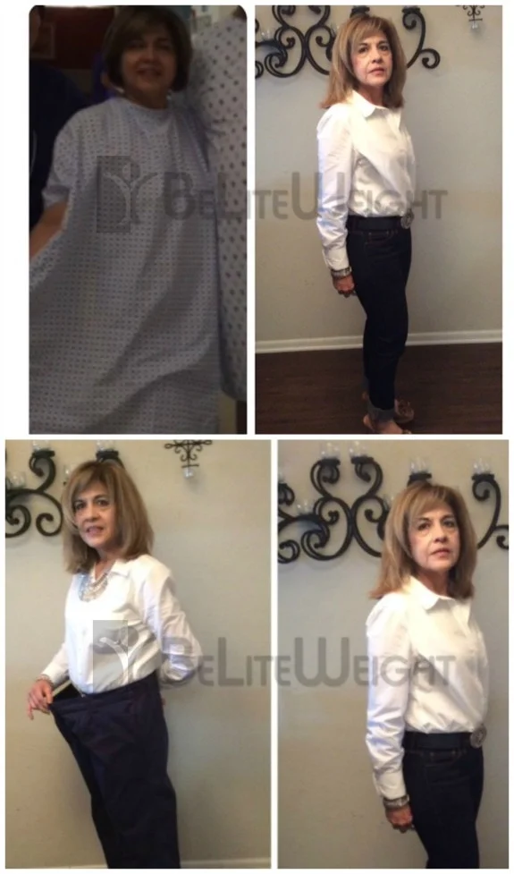 Weight Loss Surgery before and after Woman - Celia was a size 16 and now she is a size 4* one year after...