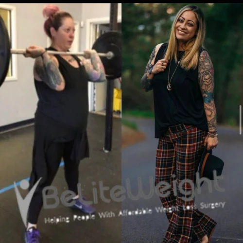 Weight Loss Surgery Before And After
