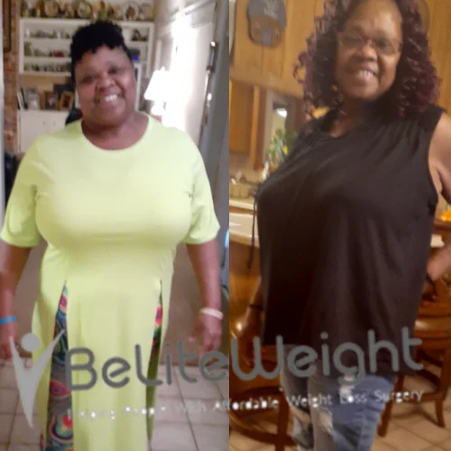 Weight Loss Surgery Before And After