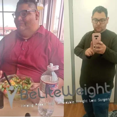 Weight Loss Surgery Before And After